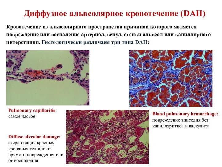 Диффузное альвеолярное кровотечение (DAH) Кровотечение из альвеолярного пространства причиной которого