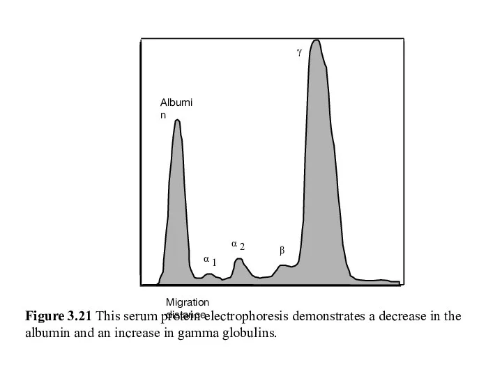 Figure 3.21 This serum protein electrophoresis demonstrates a decrease in the albumin and