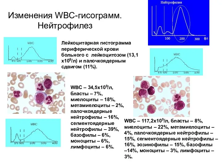 Изменения WBC-гисограмм. Нейтрофилез Лейкоцитарная гистограмма периферической крови больного с лейкоцитозом (13,1х109/л) и палочкоядерным