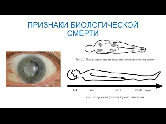 ПРИЗНАКИ БИОЛОГИЧЕСКОЙ СМЕРТИ