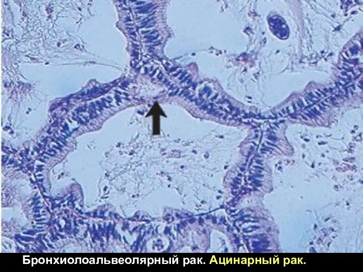 Бронхиолоальвеолярный рак. Ацинарный рак.