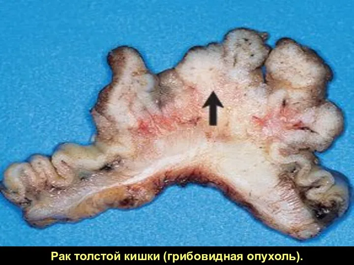 Рак толстой кишки (грибовидная опухоль).