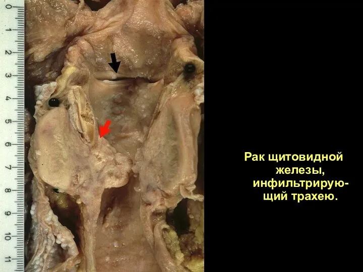 Рак щитовидной железы, инфильтрирую-щий трахею.