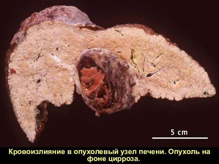 Кровоизлияние в опухолевый узел печени. Опухоль на фоне цирроза.