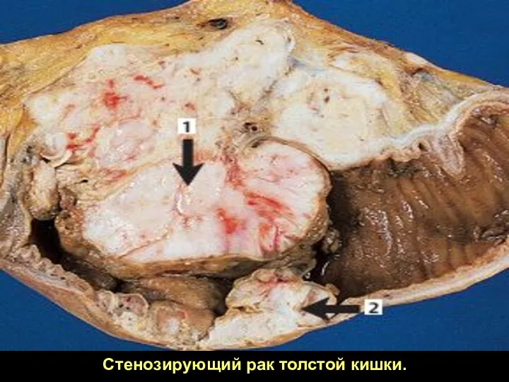 Стенозирующий рак толстой кишки.