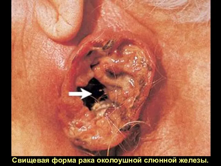 Свищевая форма рака околоушной слюнной железы.