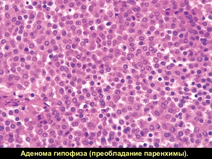 Аденома гипофиза (преобладание паренхимы).