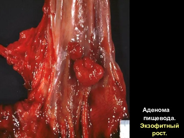 Аденома пищевода. Экзофитный рост.