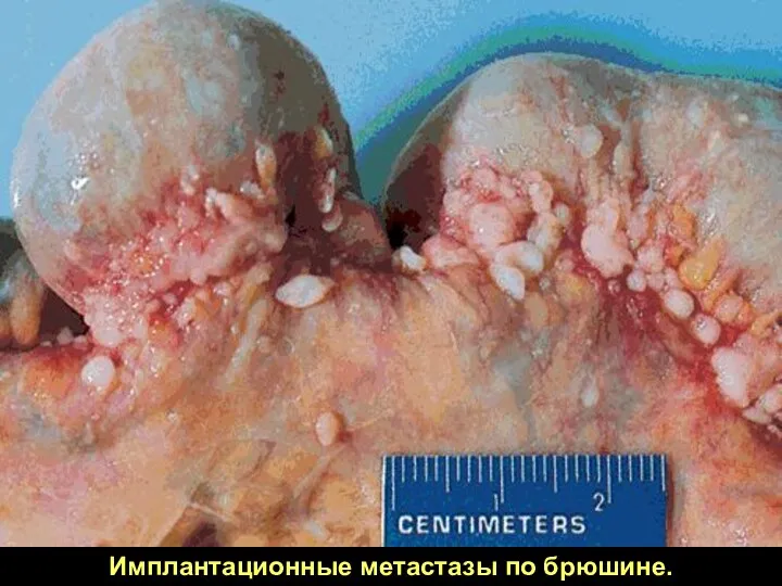 Имплантационные метастазы по брюшине.