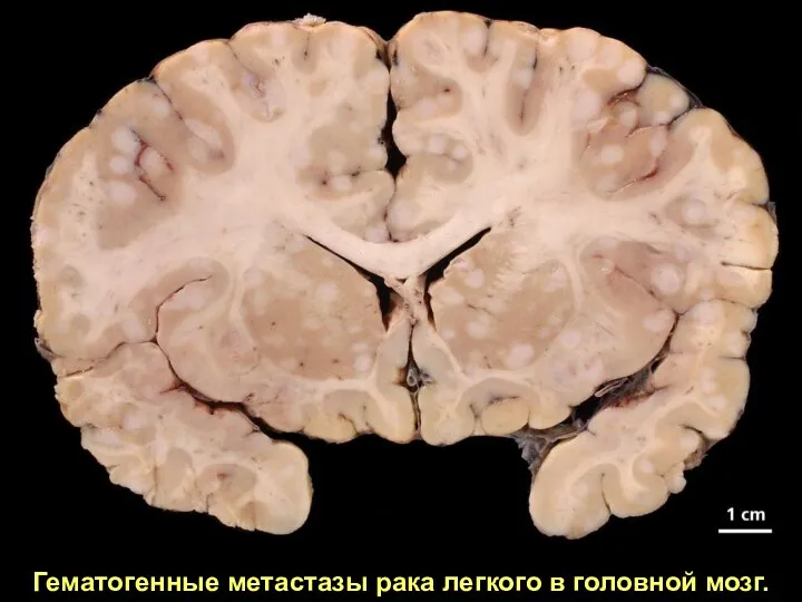 Гематогенные метастазы рака легкого в головной мозг.