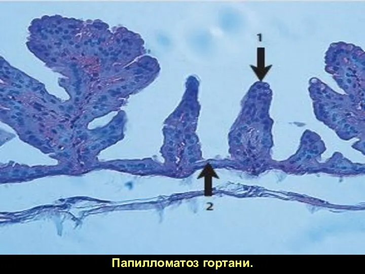 Папилломатоз гортани.