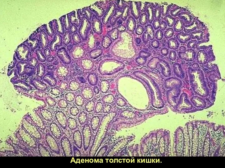 Аденома толстой кишки.