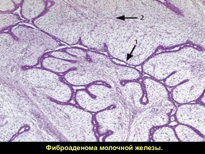 Фиброаденома молочной железы.