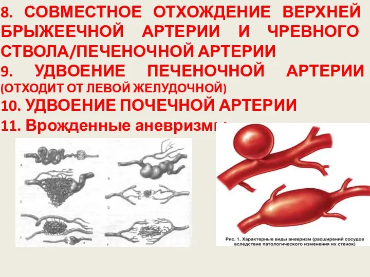 8. СОВМЕСТНОЕ ОТХОЖДЕНИЕ ВЕРХНЕЙ БРЫЖЕЕЧНОЙ АРТЕРИИ И ЧРЕВНОГО СТВОЛА/ПЕЧЕНОЧНОЙ АРТЕРИИ 9. УДВОЕНИЕ ПЕЧЕНОЧНОЙ