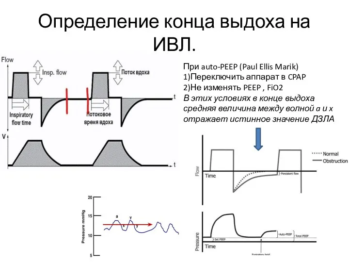 Определение конца выдоха на ИВЛ. При auto-PEEP (Paul Ellis Marik)