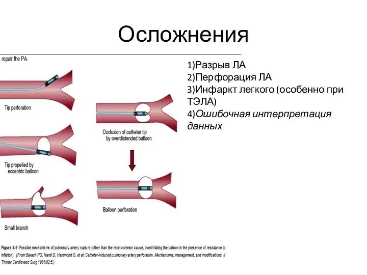 Осложнения 1)Разрыв ЛА 2)Перфорация ЛА 3)Инфаркт легкого (особенно при ТЭЛА) 4)Ошибочная интерпретация данных