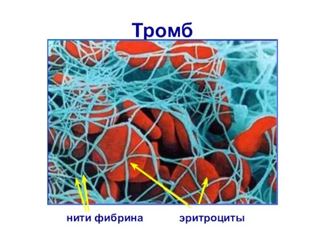 Тромб нити фибрина эритроциты