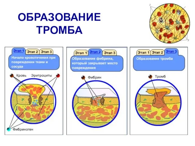 ОБРАЗОВАНИЕ ТРОМБА