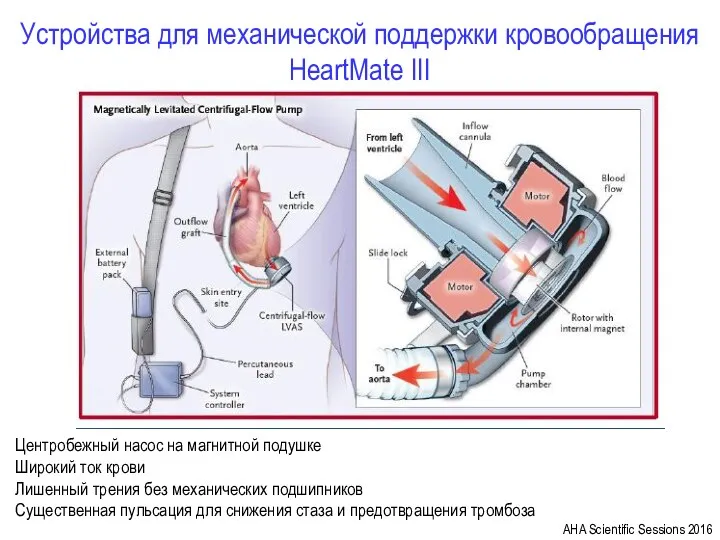 Устройства для механической поддержки кровообращения HeartMate III AHA Scientific Sessions
