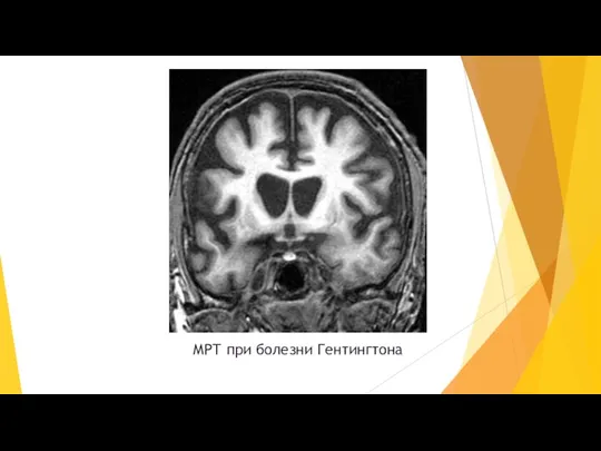 МРТ при болезни Гентингтона