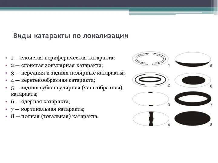 Виды катаракты по локализации 1 — слоистая периферическая катаракта; 2