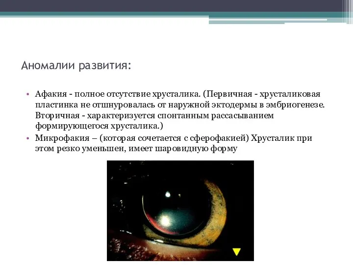 Аномалии развития: Афакия - полное отсут­ствие хрусталика. (Первичная - хрусталиковая