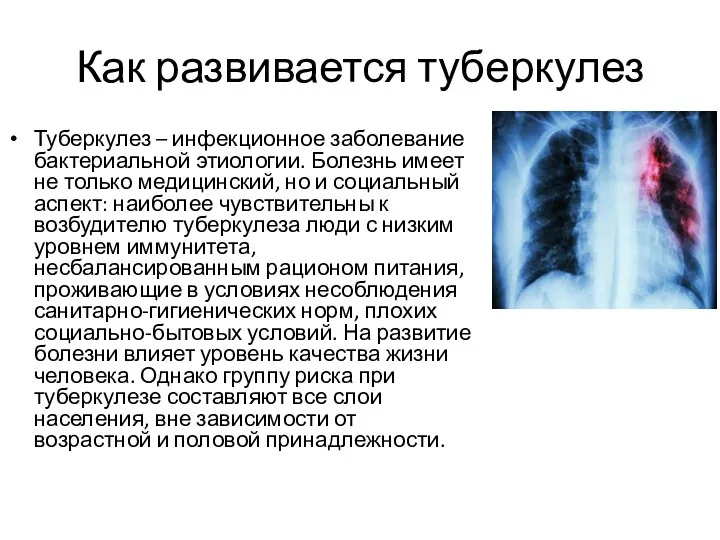 Как развивается туберкулез Туберкулез – инфекционное заболевание бактериальной этиологии. Болезнь