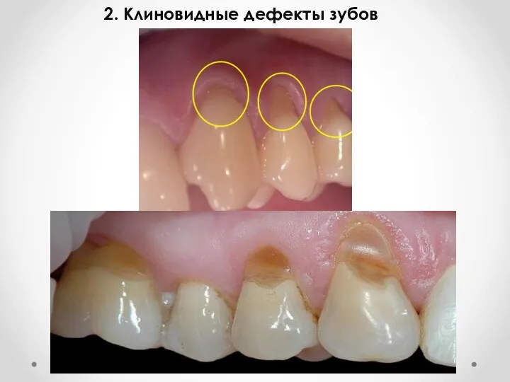 2. Клиновидные дефекты зубов