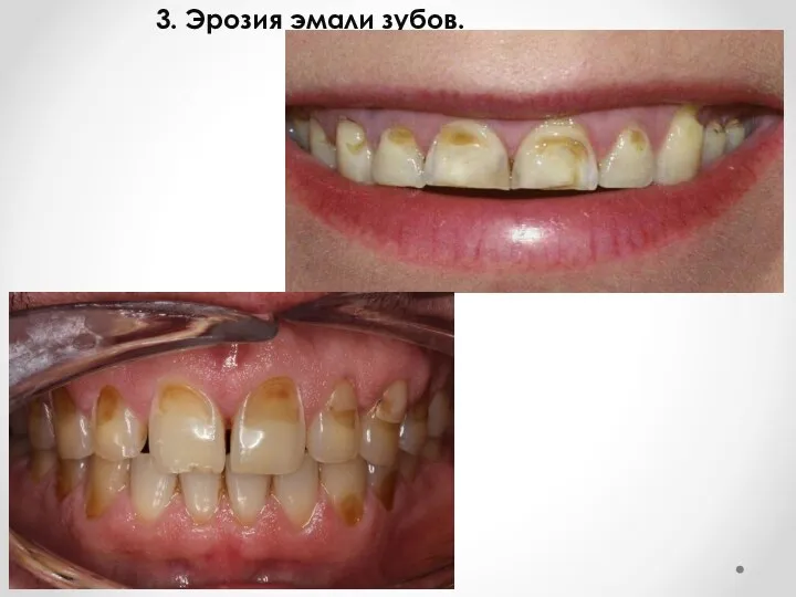 3. Эрозия эмали зубов.