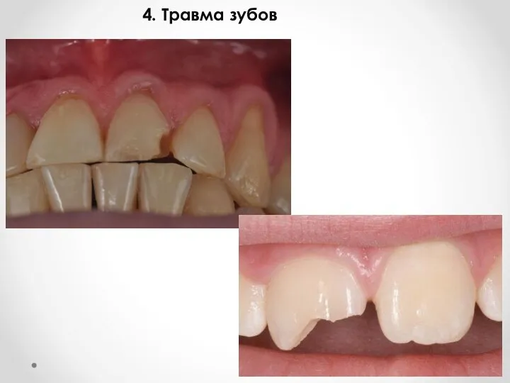 4. Травма зубов