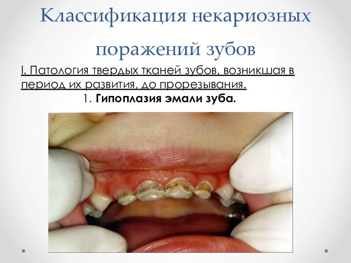 Классификация некариозных поражений зубов I. Патология твердых тканей зубов, возникшая