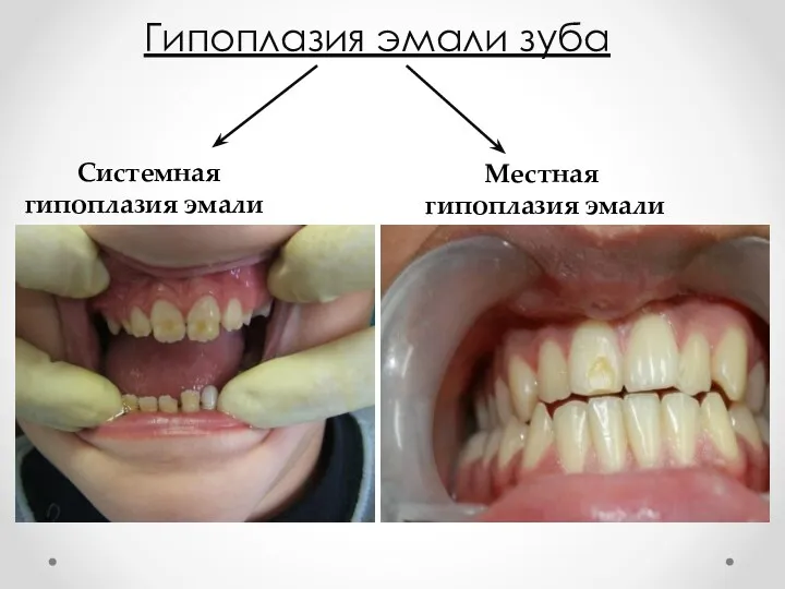 Гипоплазия эмали зуба Системная гипоплазия эмали Местная гипоплазия эмали