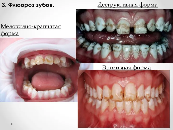 3. Флюороз зубов. Эрозивная форма Меловидно-крапчатая форма Деструктивная форма