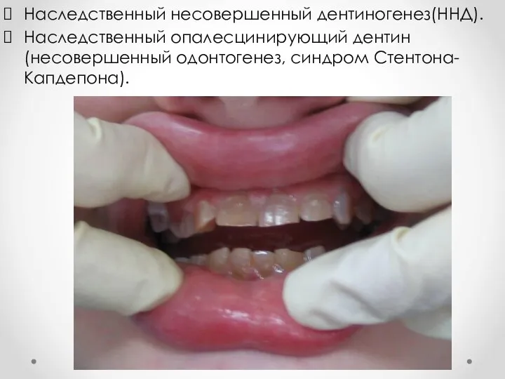 Наследственный несовершенный дентиногенез(ННД). Наследственный опалесцинирующий дентин (несовершенный одонтогенез, синдром Стентона-Капдепона).