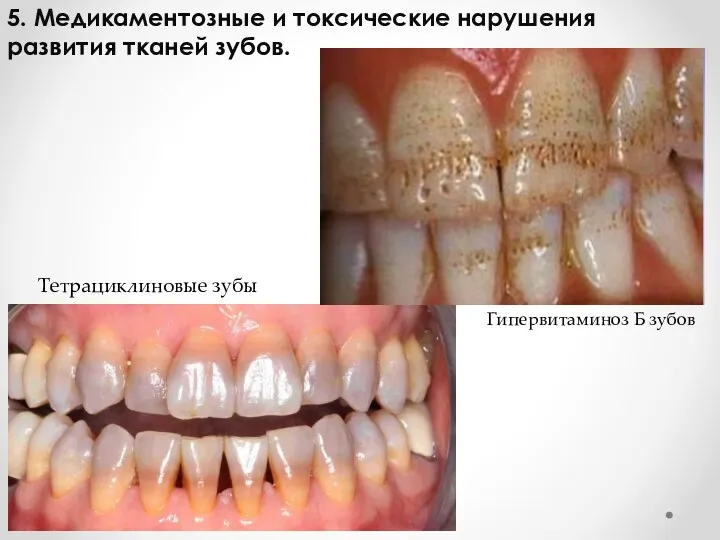 5. Медикаментозные и токсические нарушения развития тканей зубов. Тетрациклиновые зубы Гипервитаминоз Б зубов