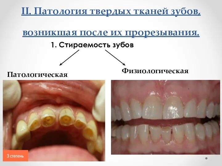 II. Патология твердых тканей зубов, возникшая после их прорезывания. 1. Стираемость зубов Патологическая Физиологическая