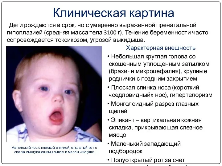 Дети рождаются в срок, но с умеренно выраженной пренатальной гипоплазией (средняя масса тела