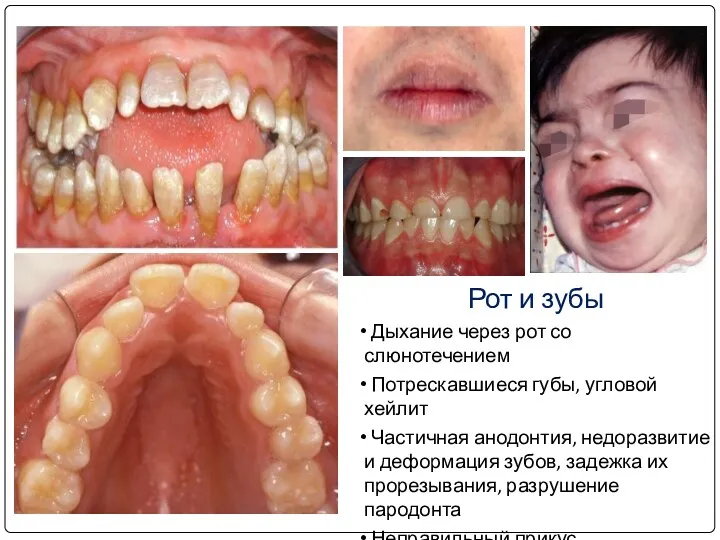 Дыхание через рот со слюнотечением Потрескавшиеся губы, угловой хейлит Частичная анодонтия, недоразвитие и