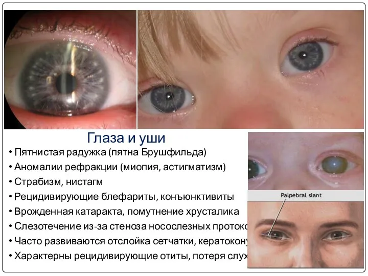 Глаза Пятнистая радужка (пятна Брушфильда) Аномалии рефракции (миопия, астигматизм) Страбизм, нистагм Рецидивирующие блефариты,