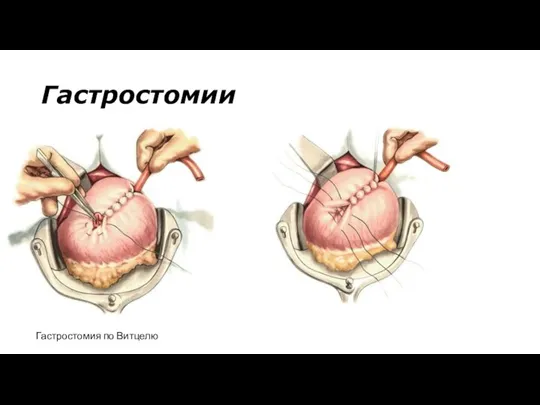 Гастростомии Гастростомия по Витцелю