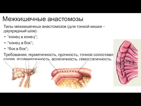 Межкишечные анастомозы Типы межкишечных анастомозов (для тонкой кишки – двухрядный