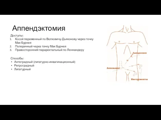 Аппендэктомия Доступы: Косой переменный по Волковичу-Дьяконову через точку Мак Бурнея