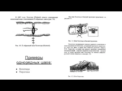 Примеры однорядных швов: Холстеда Пирогова