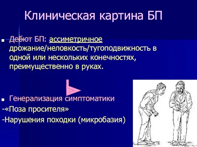 Клиническая картина БП Дебют БП: ассиметричное дрожание/неловкость/тугоподвижность в одной или