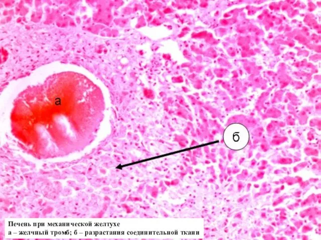 Печень при механической желтухе а – желчный тромб; б – разрастания соединительной ткани