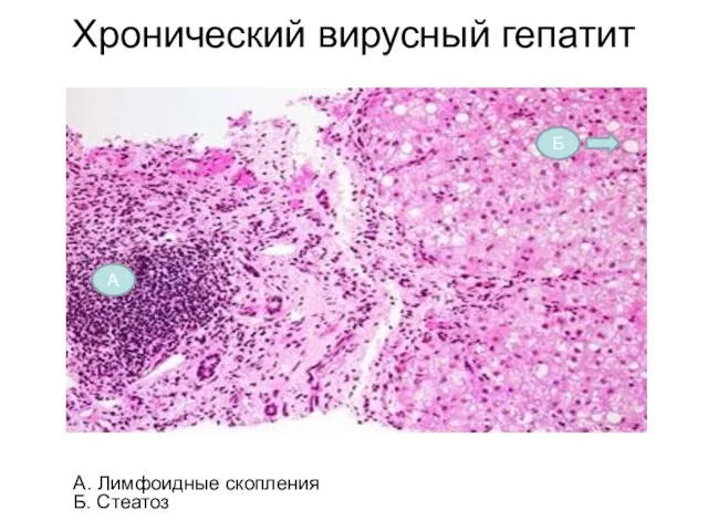 Хронический вирусный гепатит А. Лимфоидные скопления Б. Стеатоз А Б