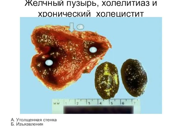 Желчный пузырь, холелитиаз и хронический холецистит А. Утолщенная стенка Б. Изъязвления Б Б А