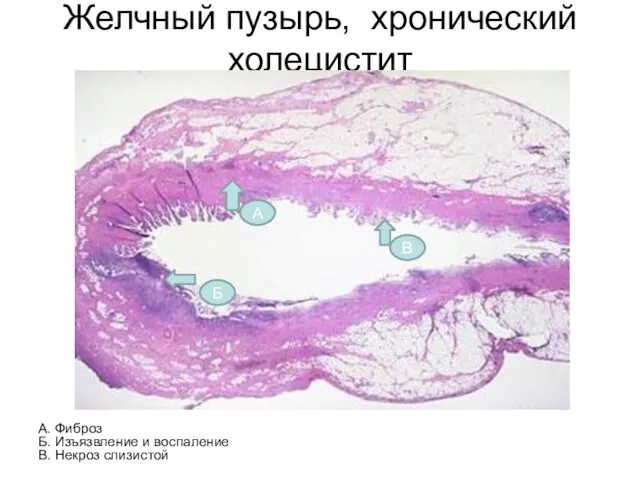 Желчный пузырь, хронический холецистит А. Фиброз Б. Изъязвление и воспаление В. Некроз слизистой А Б В