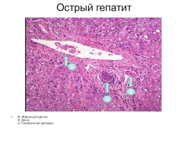 Острый гепатит А. Желчный проток б. Вена в. Печеночная артерия В А Б