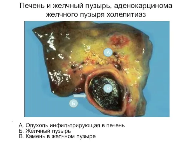 Печень и желчный пузырь, аденокарцинома желчного пузыря холелитиаз А. Опухоль